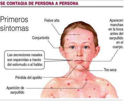 Confirman el primer caso de sarampión autóctono en la Ciudad de Buenos Aires